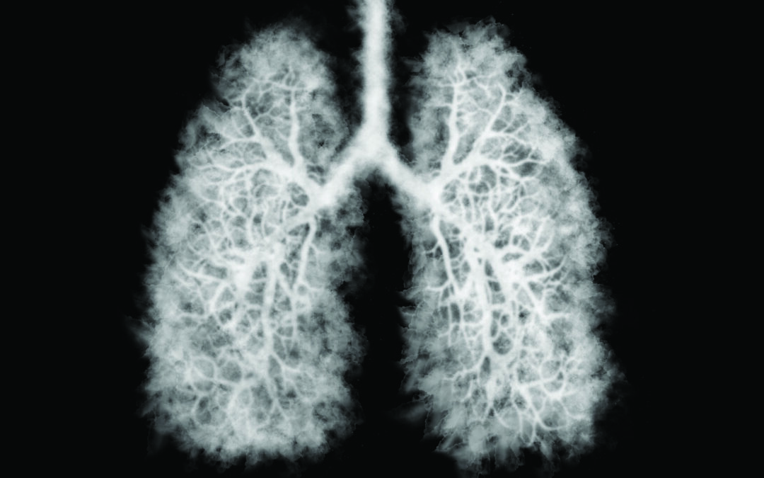 New Lung Cancer Screening Recommendations